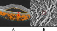 Choroidal blood flow changes in central serous chorioretinopathy - Scientific Reports