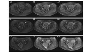 New Imaging Technique Revolutionizes Assessment Of Uterine Fibroid Blood Flow