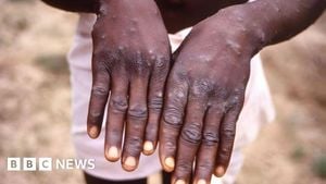 First Case Of Severe Mpox Strain Confirmed