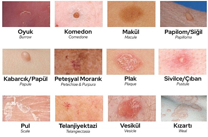 Deride oluşabilecek çeşitli problemler. Bunların hepsi maymun çiçeği hastalığında görülmez.