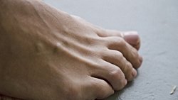 Diyabetik Ayak Nedir? Neden Gelişir, Nasıl Önlenir?