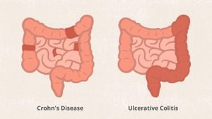 Mapping Cellular Changes In Ulcerative Colitis Pouches