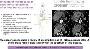 New Machine Learning Models Predict Hepatocellular Carcinoma Recurrence After Liver Transplantation