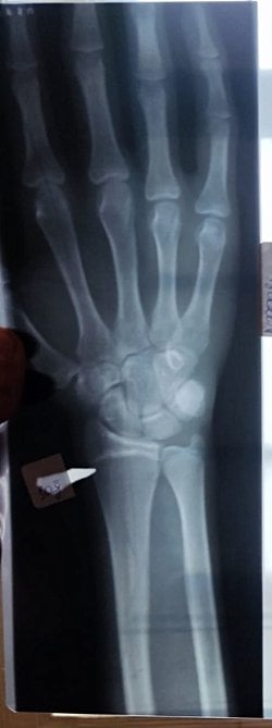 18 den sonra boy uzanırmı Epifiz plaklarim kapanmaya yaklasmış bir kaç sm daha uzaya bilsem iyi olur?