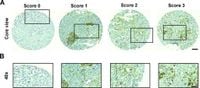 Increased primary breast tumor expression of CD73 is associated with development of bone metastases and is a potential biomarker for adjuvant bisphosphonate use - Scientific Reports