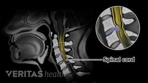 New Study Measures Sodium Levels In Cervical Myelopathy Using MRI