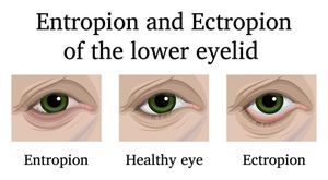 National Study Links Eyelid Disorders To Systemic Diseases