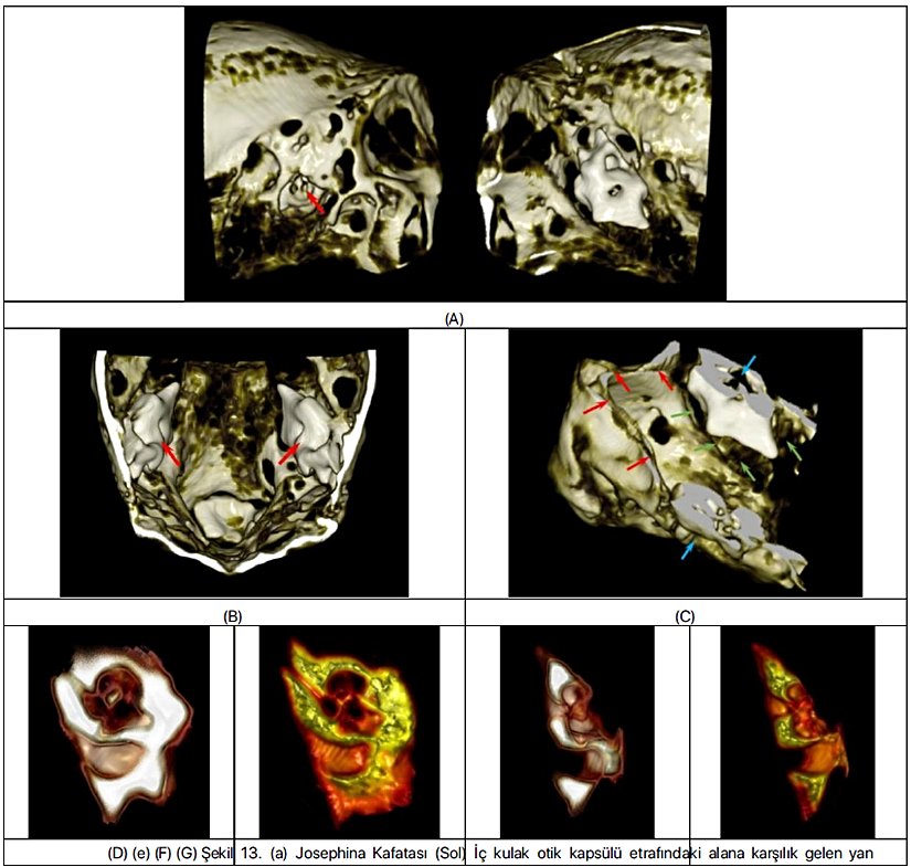 13. (a) Joseph(ein) a Kafatası (Sol) İç kulak otik ( kFa) psülü etrafındaki alana karşılık( G g)e len yan Şekil  görünüm. Kırmızı ok kafatasının içindeki kapsülü gösteriyor. (Sağ) Kapsülü içeriden gösteren sagital kesit. (b) İç kulağın otik  kapsüllerinin konumlarını gösteren enine kesit (kırmızı oklar). (c) Kırmızı okların burun deliklerini iç kulağa birleştiren iki geçidi  gösterdiği enine kesit. Yeşil oklar, iç kulağın otik kapsülü etrafındaki geniş boş alanı göstermektedir. Mavi oklar kafatasının  bozulmuş bölgesini gösteriyor ve kemik kapsülünün sınırsız bir şekilde görülebilmesini sağlıyor. (d)–(e) İç özellikleri gösteren  iç kulak otik kapsül bölümleri.