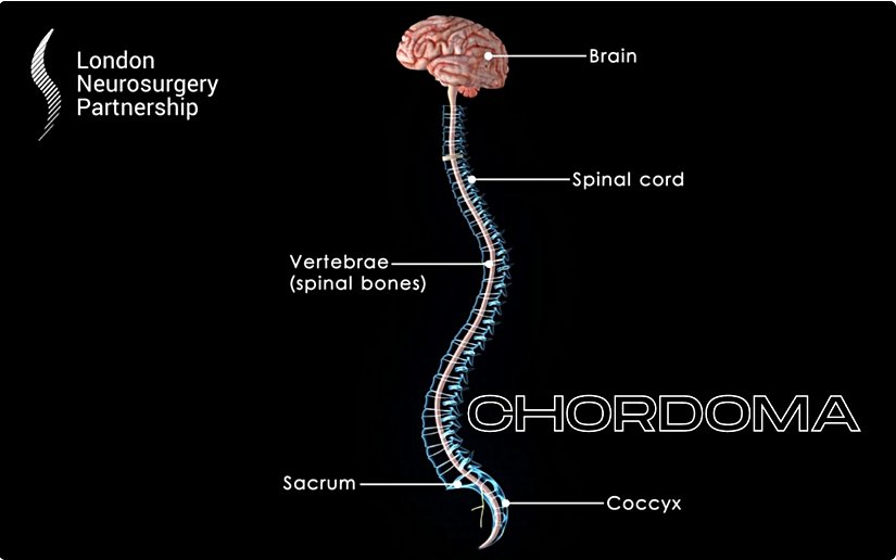 Kordoma gelişme lokasyonları