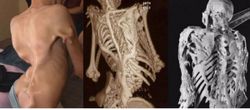 Taş Adam Sendromu (Fibrodysplasia Ossificans Progressiva)