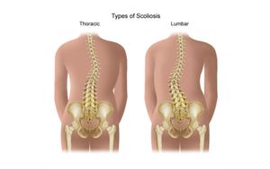 Spinal Manipulation Improves Movement Patterns In Scoliosis