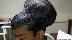 Tespit Edilen En Büyük Beyin Tümörü!