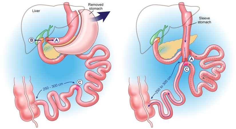 Duodenal switch, diğer bariatrik prosedürlerle karşılaştırıldığında, süper morbid obezitesi olan hastaların kilo verme hedeflerine ulaşmalarına yardımcı olma şansı daha yüksektir. Ayrıca, özellikle uzun süre insülin tedavisine ihtiyaç duyan hastalarda, diyabet için diğer prosedürlerden daha etkilidir. Bununla birlikte, bu etkinliğin daha yüksek beslenme eksikliği riski ile dengelenmesi gerekir.