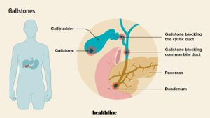 Study Links Daily Sleep Duration To Gallstone Risk