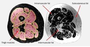 New Study Links Thigh Fat Levels To Age, Sex, And BMI