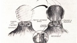 Kafa Nakli Gerçekten Mümkün mü?