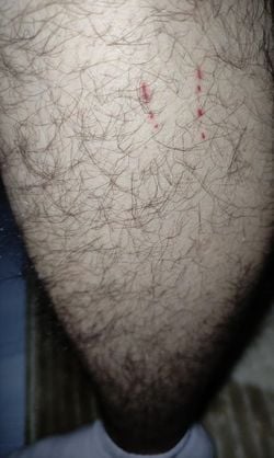 Kedi tarafınca ısırıldım, tırnaklandım kuduz, tetenoz aşımı olaydan 24 saat civarı birlikte vuruldum kedi kuduzsa tedbir için geç mi kaldım kaygılıyım?