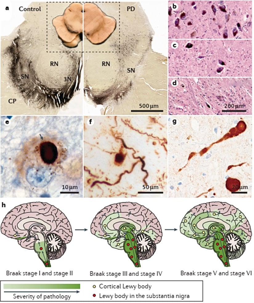 | Parkinson hastalığı için ana tanısal nöropatolojiler. a | Parkinson hastalığı (PD), kontrole (sol panel) kıyasla substantia nigra (SN) (sağ panel) depigmentasyonu ile tanımlanır. Dopamin sentezi için hız sınırlayıcı enzim olan tirozin hidroksilaz için immünohistokimyasal boyamanın ardından orta beynin makroskopik (iç) ve enine kesitleri gösterilmiştir. Daha medial ve dorsal bölgelerin korunması ile SN'nin ventrolateral kısımlarının seçici kaybı, histolojik bölümde belirgindir. b d | SN'nin ventrolateral bölgesinin hematoksilen ve eozin boyaması, sağlıklı bir kontrolde (bölüm b) normal bir pigmentli nöron dağılımı ve PD'de tanısal olarak önemli (bölüm c) veya şiddetli (bölüm d) pigmente hücre kaybı gösterir. e – g | Α ‑ sinükleinin immünohistokimyasal boyaması, yuvarlak, intrasitoplazmik Lewy cisimcikleri (bölüm e'deki ok), daha yaygın, granüler α ‑ sinüklein birikintilerini (kısım e ve kısım f), nöronal hücre süreçlerinde birikintileri (kısım f), hücre dışı nokta- aksonlardaki α ‑ sinüklein yapıları (kısım f) ve α ‑ sinüklein sferoidleri (kısım g) gibi. h | Alzheimer patolojisi olmadan PD'de α ‑ sinüklein agregasyonunun teorik ilerlemesi. α ‑ Sinüklein kapanımları, asemptomatik vakalarda kolinerjik ve monoaminerjik alt beyin sapı nöronlarında meydana gelir (Braak evre I ve evre II), PD'nin motor semptomları olanlarda (Braak evre III ve evre IV) orta beyindeki ve bazal ön beyindeki benzer nöronlara sızar, ve daha sonra hastalığın ilerlemesi olan limbik ve neokortikal beyin bölgelerinde bulunur (Braak evre V ve evre VI)