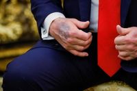 Trump reveals dark bruising on hand as he goes cover-up-free in Oval Office amid health concerns