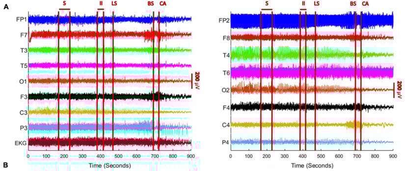 Bu grafikte, sol taraftaki grafik sol beynin, sağ taraftaki grafik sağ beynin faaliyetini göstermektedir. Bu grafikler, her iki tarafta 8'erden toplam 16 ayrı elektrottan gelen elektrik sinyalleri yansıtmaktadır. Grafikte, en altta EKG olarak isimlendirilmiş grafik ise hastanın kalbinden toplanan sinyallerdir. Grafiklerde zaman, soldan sağa doğru akmaktadır.