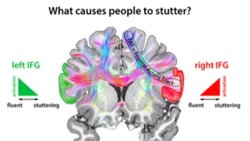 Kekemeliğe detaylı bir bakış
