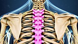 Torakal Disk Hernisi Nedir ?