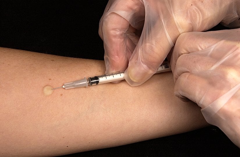 Mantoux tüberkülin deri testi, insanları gizli tüberküloz enfeksiyonu açısından değerlendirmek için kullanılır. Bu intradermal enjeksiyonun doğru yerleştirilmesi, iğne ucunun 5° ila 15°'lik bir açıyla yavaşça yerleştirilmesini içerir. İğne ucu, derinin yüzeysel tabakası olan epidermis boyunca yaklaşık 3 mm ilerletilir, böylece ucun tamamı kaplanır ve deri yüzeyinin hemen altında kalır. İğne eğiminin üzerinde 6 mm ila 10 mm çapında gergin, soluk bir kabarıklık belirir.