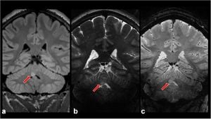 New Insights Into Meningioma Monitoring With TERRA Biomarkers