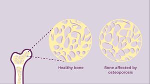 Alarming Bone Health Issues Found Among Female Breast Cancer Patients