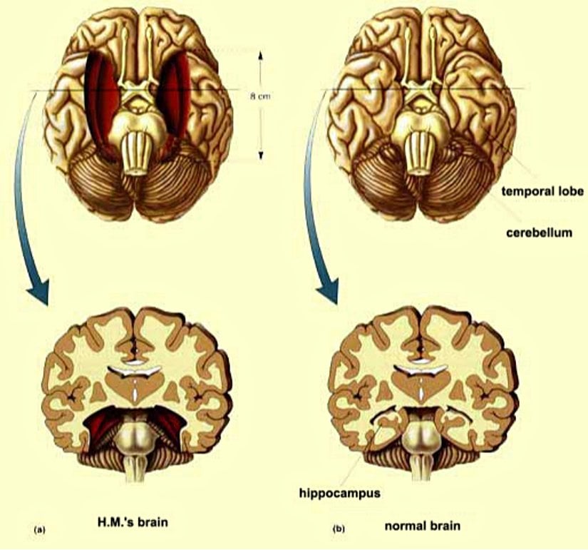 Görsel, retrograd amnezi üzerine yapılan çalışmalarda sıkça incelenen H.M. vakasını temsil etmektedir. Sol tarafta (a) H.M.'nin beyni görülmektedir; temporal loblarının büyük bir kısmı ve hipokampus cerrahi olarak çıkarılmıştır. Sağ tarafta (b) ise sağlıklı bir beynin yapısı gösterilmektedir. Hipokampusun çıkarılması, H.M.’nin yeni anılar oluşturma yetisini kaybetmesine ve retrograd amnezi semptomları yaşamasına neden olmuştur. Bu vaka, hipokampusun hafıza oluşumundaki kritik rolünü anlamamıza önemli katkılar sağlamıştır.