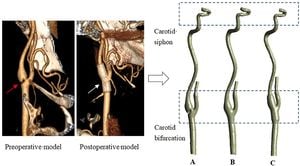 New Insights On How Carotid Stenosis Affects Blood Flow Dynamics