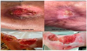 Lyophilized Stem Cells And PRF Accelerate Wound Healing