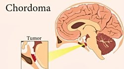 Kordoma Kanseri Nedir? Embriyonun Ölümcül Artığı Nasıl Oluşur ve Nasıl Tedavi Edilir?