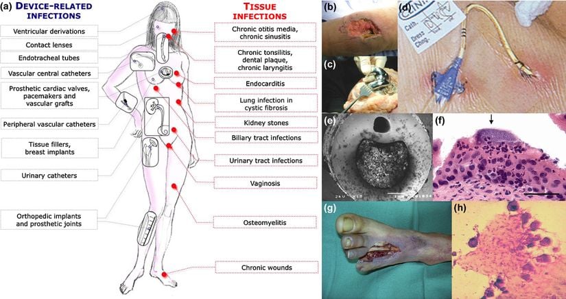 Şekil. Doku ve tıbbi cihaz kaynaklı biyofilm enfeksiyonları