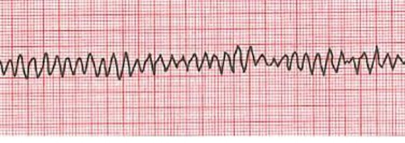 ventriküler fibrilasyon