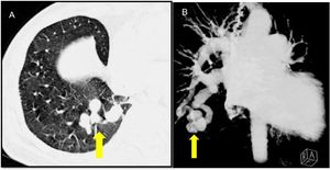 New Insights On MiR-25-3p's Role In Post-Surgery Complications