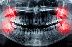 Eskiden insanlar yirmilik dişlerle nasıl baş ederdi?