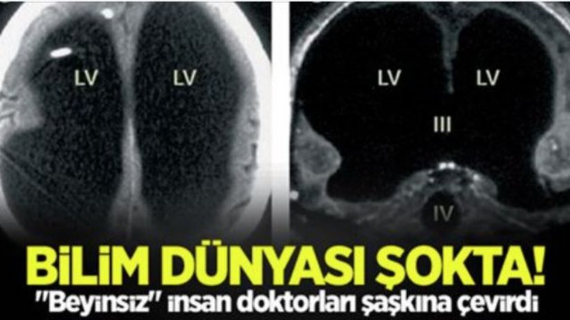 2) Yunanlı psikiyatristler 2003’te kafatasının içinde beyninin olmadığına inanan bir insanla karşılaştı. Bu kişi önce yaşamasının hiçbir anlamı olmadığına inanarak intihar girişiminde bulunmuş ve sonrasında tedavi edilmeden işine dönmüş. Bir süre sonra bu kez beyni olmadan doğduğunu iddia etmiş. Tedaviden aylar sonra iyileşme göstermiş.
