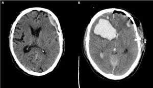 Timing Of Anticoagulation May Reduce Risks In Brain Injury Patients