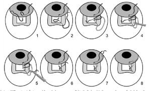 Revolutionary Glaucoma Surgery Shows Promising Results