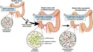 Fecal Microbiota Transplantation Shows Promise Against Graft-Versus-Host Disease