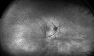 New Study Shows Increased Autofluorescence In Uveitis Patients