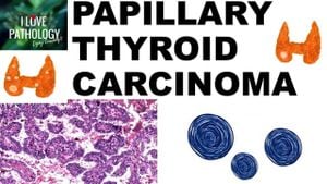 Exploring M5C-lncRNAs: A New Prognostic Marker For Papillary Thyroid Cancer