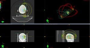 Comparative Study Highlights Benefits Of VMAT And DCAT For Brain Metastases Treatment