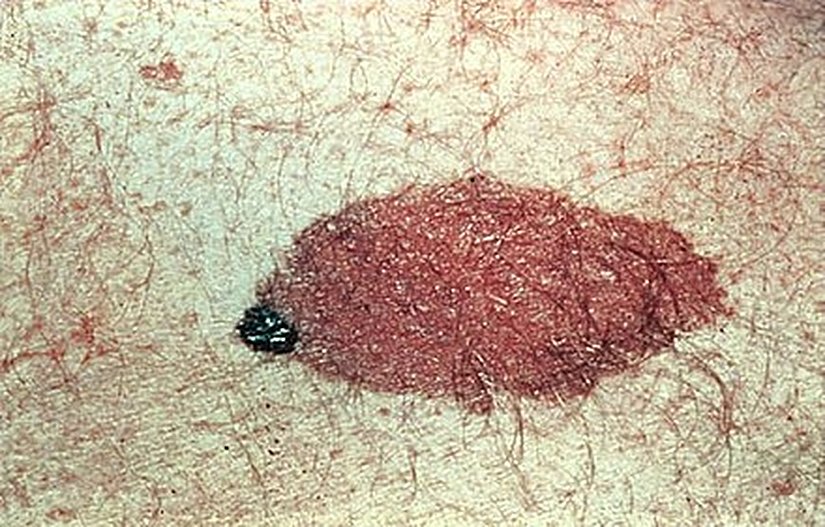 Congenital Melanocytic Nevus