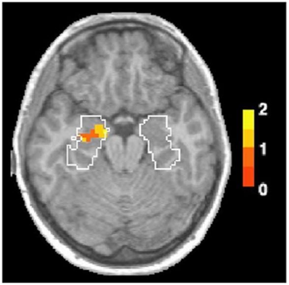 Koku bağlantılı ve resim bağlantılı anılar için beyin aktivitesindeki farkı gösteren bir FMRI taraması. Bu görüntü, sanki ona yukarıdan bakıyormuşsunuz gibi, birinin kafasının üst kısmından beyin taramasını gösteriyor. Beyaz çerçeve, amigdala ve hipokampüsü içeren beynin bölümlerini göstermektedir. Renkler, insanların kokulara ve resimlere tepki olarak anıları olduğunda beyin aktivitesindeki farklılığın ne kadar büyük olduğunu gösteriyor; sarı ise en büyük farkı gösteriyor.