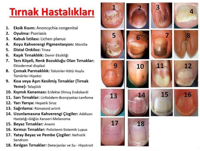 Tırnaklar ve Olası Hastalıklar