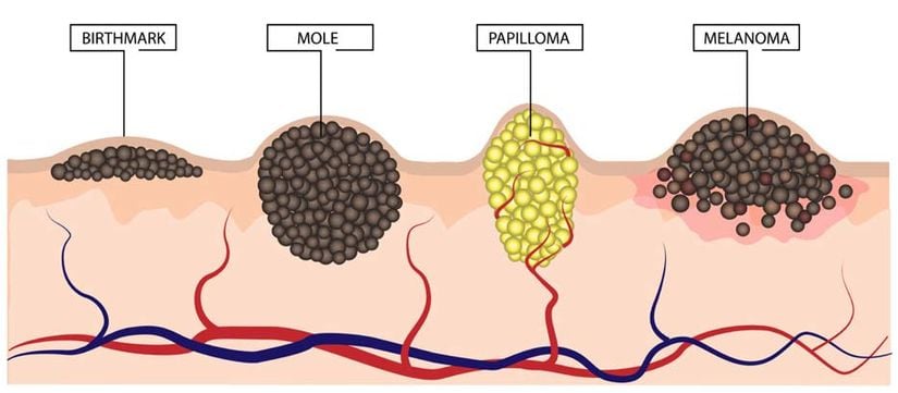 Doğum lekesi, Nevüs, Siğil ve Melanomun arasındaki farklılıklar