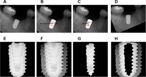 Study Confirms Deep Learning Can Predict Immediate Implant Placement