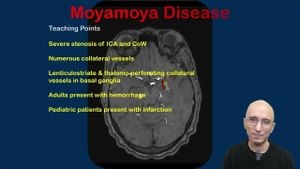 Significant Gray Matter Network Changes Observed In Moyamoya Disease Patients